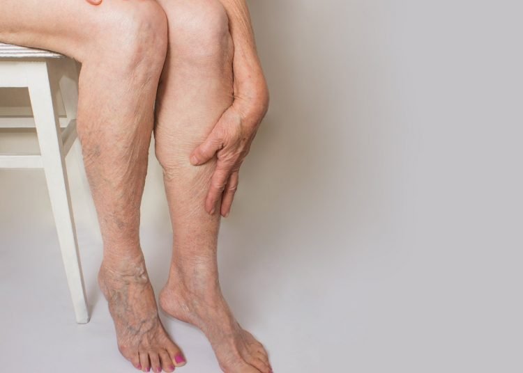 Médico cardiologista alerta sobre os cinco sinais de trombose venosa profunda